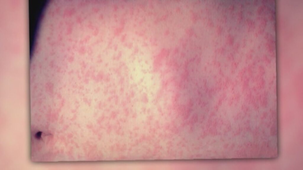 Gov. Hochul declares measles disaster emergency